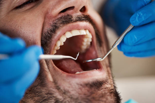 Best Knocked-Out Tooth (Avulsed Tooth) Treatment in Nacogdoches, TX