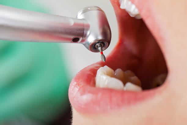 Best Emergency Treatment for Oral Infections in Nacogdoches, TX